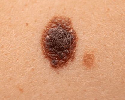 Hudcancer - orsak, symtom och behandling | Dr Hud