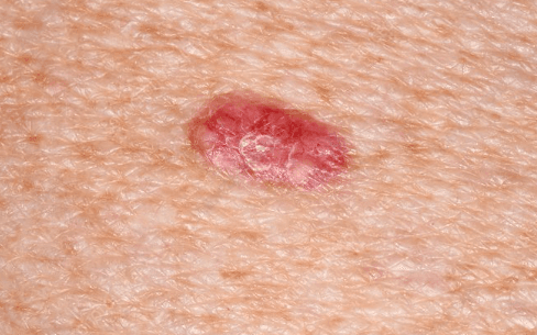 Hudcancer - orsak, symtom och behandling | Dr Hud