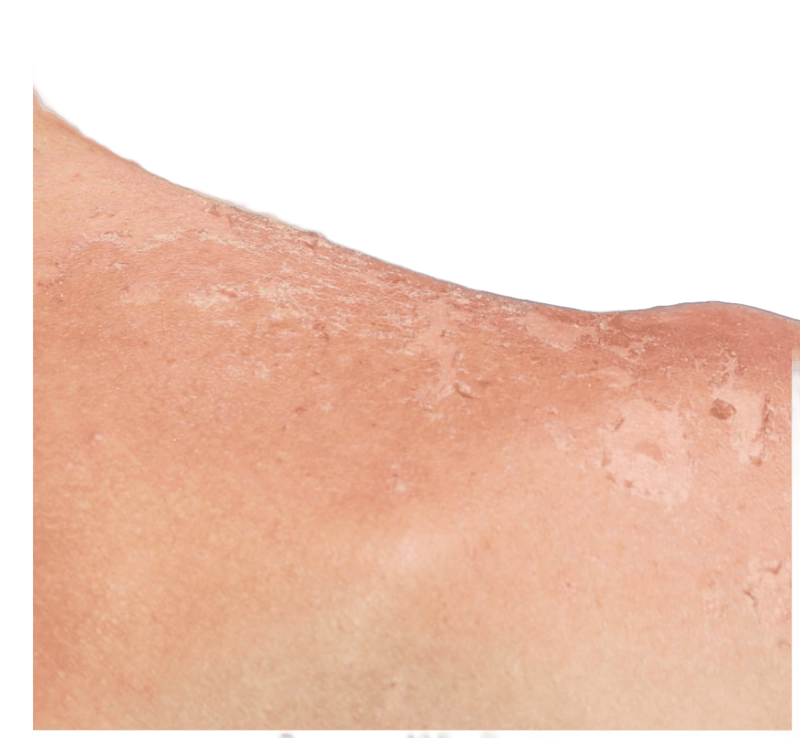 Brännskada - orsak, symtom och behandling | Dr Hud