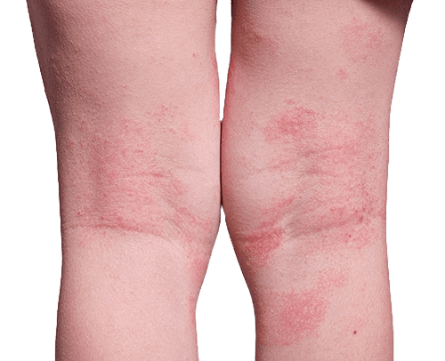 Eksem Orsak Symtom Och Behandling Dr Hud eksem-orsak-symtom-och-behandling-dr-hud