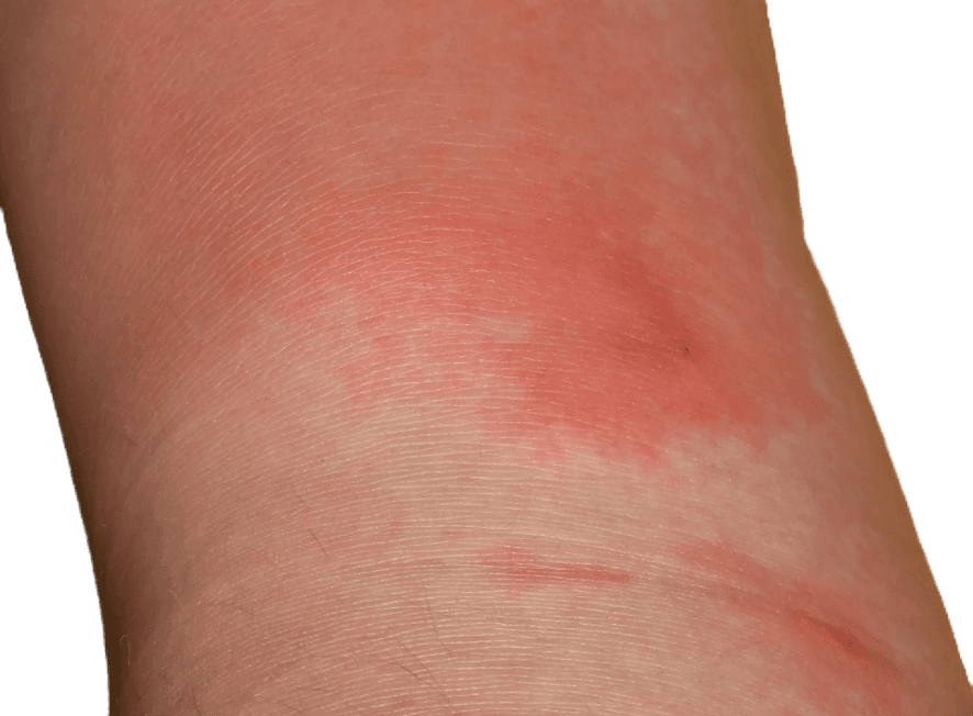 Rosfeber Orsak Symtom Och Behandling Dr Hud rosfeber-orsak-symtom-och-behandling-dr-hud