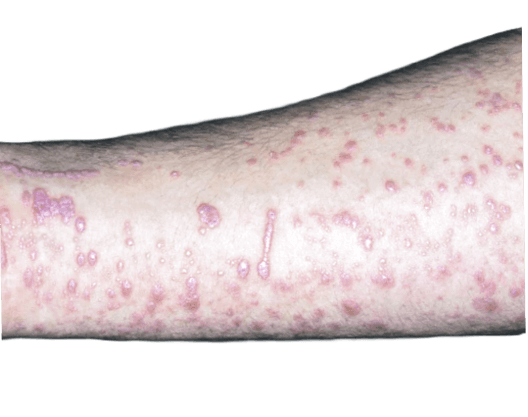 Lichen planus - orsak, symtom och behandling | Dr Hud