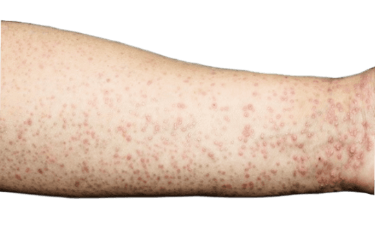 Lichen planus - orsak, symtom och behandling | Dr Hud