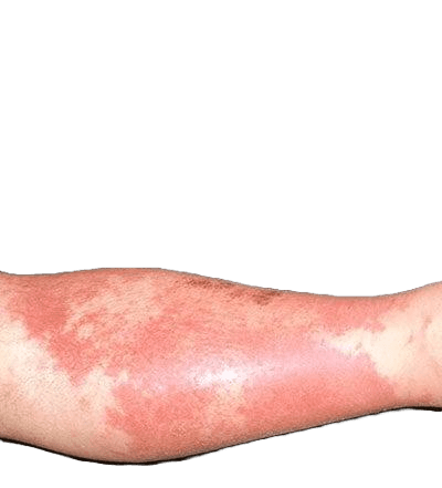 Rosfeber Orsak Symtom Och Behandling Dr Hud rosfeber-orsak-symtom-och-behandling-dr-hud