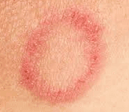 Ringorm Orsak Symtom Och Behandling Dr Hud ringorm-orsak-symtom-och-behandling-dr-hud